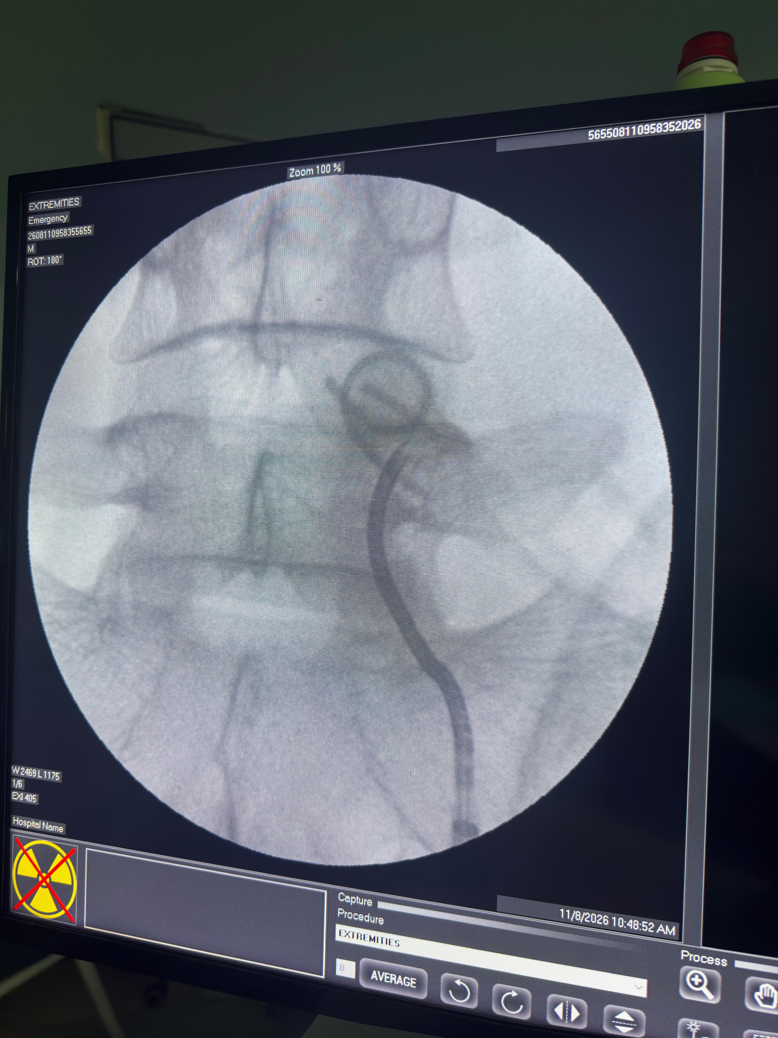 RIRS to remove a forgotten fragmented DJ Stent in an Ectopic Pelvic Kidney